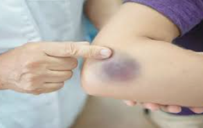 5 ways to heal bruises to heal quickly